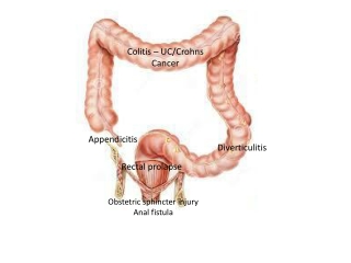 Appendicitis