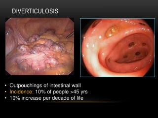 Diverticulosis