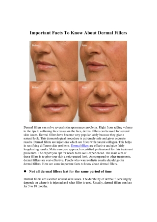 Important Facts To Know About Dermal Fillers