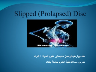 Slipped (Prolapsed) Disc