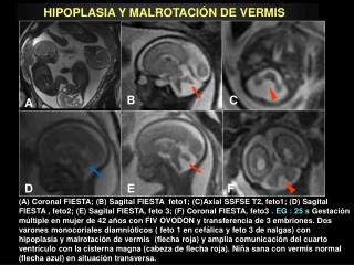 HIPOPLASIA Y MALROTACIÓN DE VERMIS