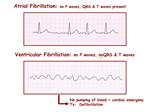 Atrial Fibrillation: no P waves, QRS T waves present