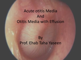 Acute otitis Media And Otitis Media with Effusion By Prof. Ehab Taha Yaseen