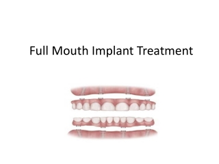 Full Mouth Implant Treatment