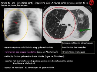 homme 52 ans , défaillance cardio-circulatoire aiguë ,4 heures après un voyage aérien de 10 heures en classe économique