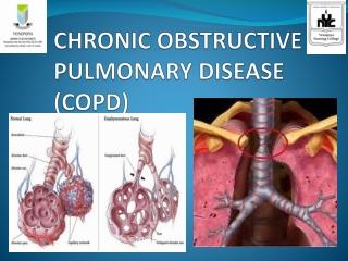 CHRONIC OBSTRUCTIVE PULMONARY DISEASE (COPD)