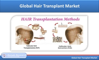 Global Hair Transplant Market is US$ 30 Billion by 2025 - Renub Research