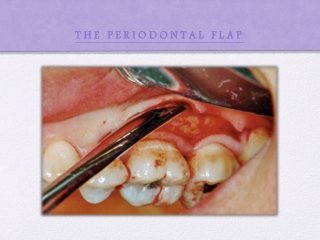 THE PERIODONTAL FLAP