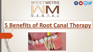 5 Benefits of Root Canal Therapy