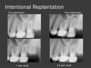 Intentional Replantation