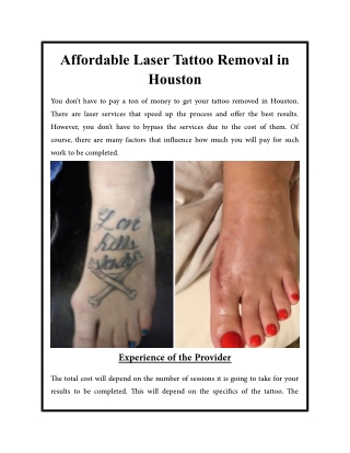 Affordable Laser Tattoo Removal in Houston