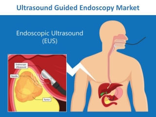 Ultrasound Guided Endoscopy Market is expected to see extensive worldwide growth
