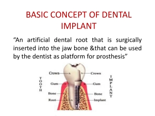 BASIC CONCEPT OF DENTAL IMPLANT