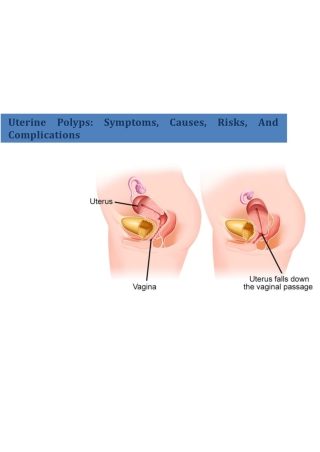 Uterine Polyps: Symptoms, Causes, Risks, And Complications