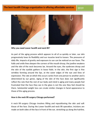 Best facelift surgeons are offering affordable facelift services.