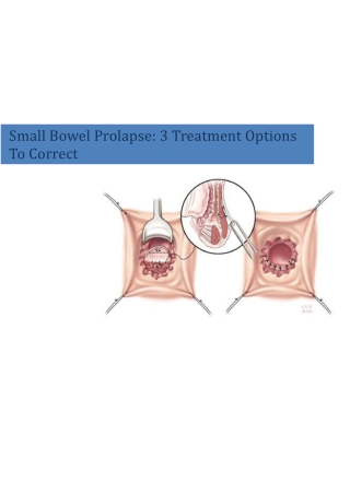 Small Bowel Prolapse: 3 Treatment Options To Correct