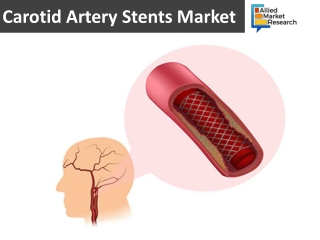 Carotid Artery Stents Market to Expand at a Steady Growth Rate in the Coming Years
