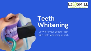 Why Teeth Whitening is popular?