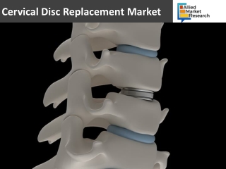 Cervical Disc Replacement Market Statistics 2019: Hyper Growth Recorded in the Future