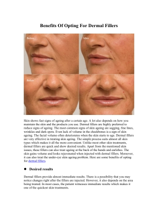 BENEFITS OF OPTING FOR DERMAL FILLERS