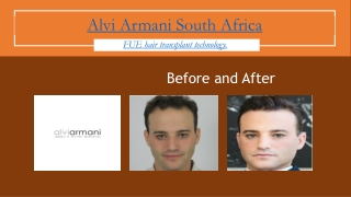 Alvi Armani South Africa Hair Transplant Johannesburg