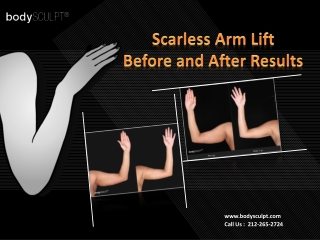 Scarless Arm Lift - Before and After Results