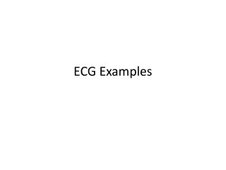 ECG Examples