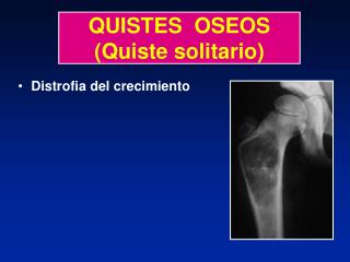 QUISTES OSEOS (Quiste solitario)