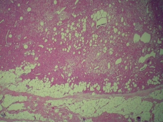 CD34: negative S-100: negative Actin: negative Desmin: negative Cytokeratin: Negative