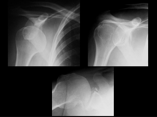 Anterior shoulder dislocation