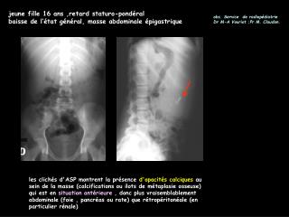 jeune fille 16 ans ,retard staturo-pondéral baisse de l’état général, masse abdominale épigastrique