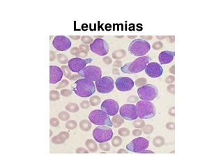 Leukemias