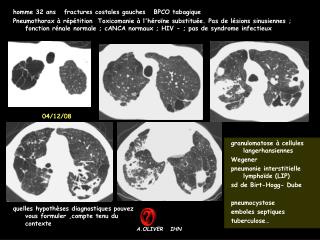 homme 32 ans fractures costales gauches BPCO tabagique