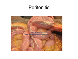 Peritonitis