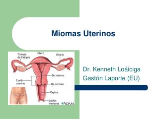 Miomas Uterinos