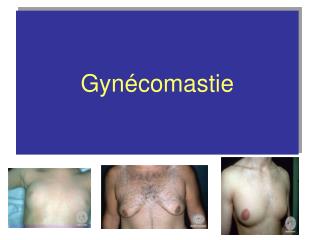 Gynécomastie