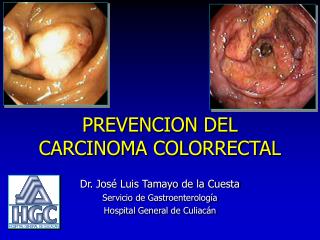 PREVENCION DEL CARCINOMA COLORRECTAL