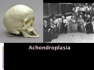 Achondroplasia