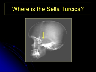 Where is the Sella Turcica?