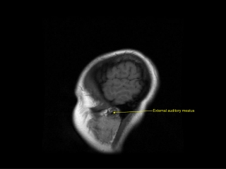 External auditory meatus