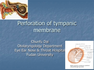 Tympanic membrane rupture PowerPoint (PPT) Presentations, Tympanic ...