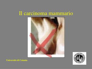 Il carcinoma mammario