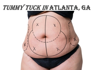 Tummy Tuck Atlanta, GA | Buckhead Tummy Tuck (Abdominoplasty)