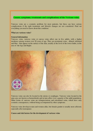 Causes, symptoms, treatments and complications of the Vericose veins.