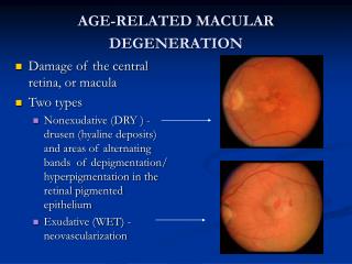 AGE-RELATED MACULAR DEGENERATION