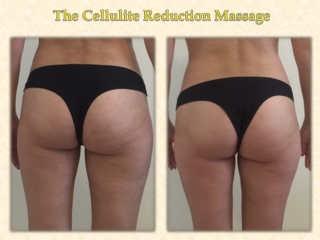 The Cellulite Reduction Massage
