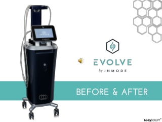 EVOLVE by InMode – Before & After