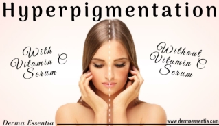 Does Vitamin C Help in Hyperpigmentation