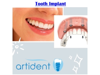 tooth implant