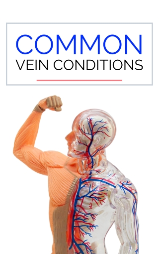 List of Common Vein Conditions